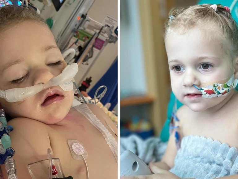 Millie needed emergency surgery to remove most of her bowel.