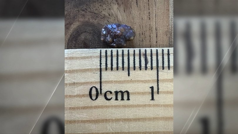 The cause of the immense pain was a 6 mm kidney stone.