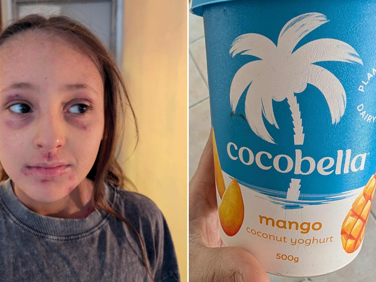 Ruby experienced a serious reaction after eating just three spoonfuls of Cocobella Mango yoghurt in 2024.