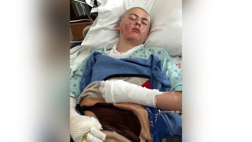 Caden Ballard, 12, suffered serious burns after a TikTok experiment went wrong.