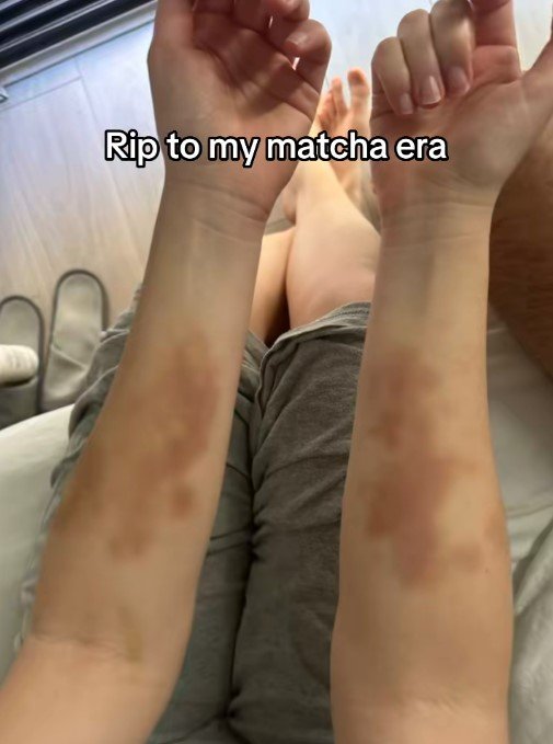 Sydney woman hospitalised after daily matcha habit