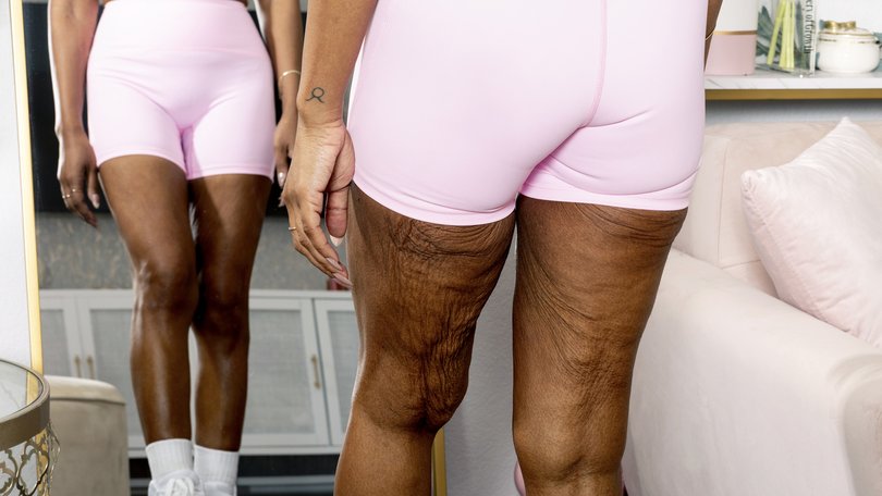 THE NEW YORK TIMES: They’ve dropped the weight, but what about the skin?