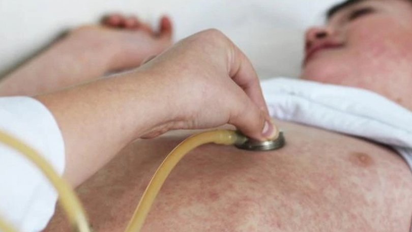 Health officials urged people to monitor for symptoms.
