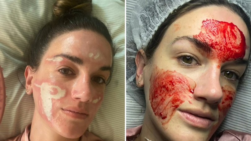 Tiktoker claims she was left 'disfigured' after famous facialist.