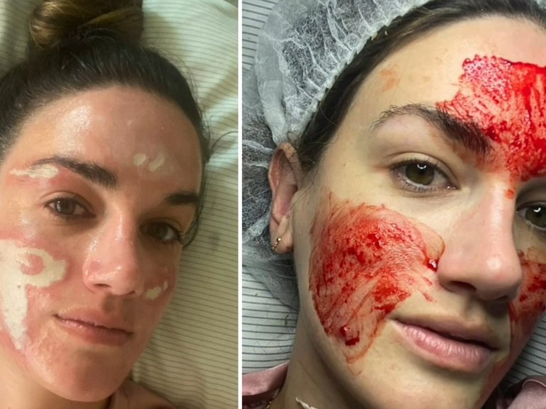 Tiktoker claims she was left 'disfigured' after famous facialist.