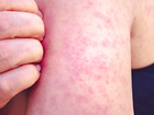 Six confirmed cases in Cairns and surrounding areas sparked an urgend health warning with Queensland Health releasing a growing list of exposure sites.