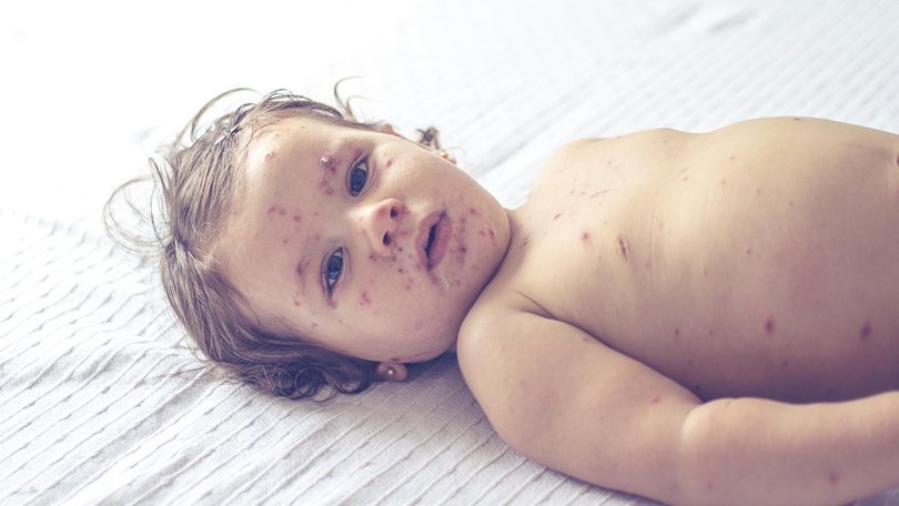 Masks are now compulsory in sections of Cairns Hospital due to a measles outbreak.