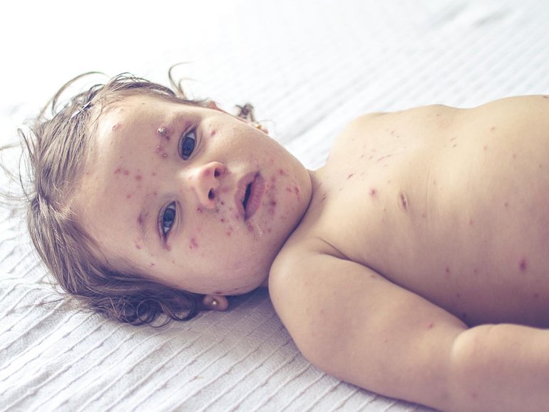 Masks are now compulsory in sections of Cairns Hospital due to a measles outbreak.