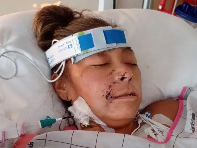 Janelle Scott lost all four of her limbs after the attack.