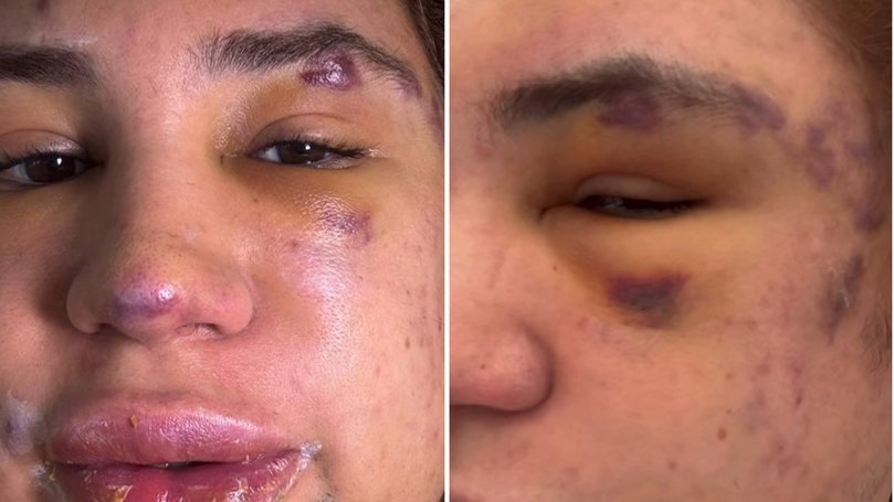 Fashion Stylist shares brusing just days after procedure.