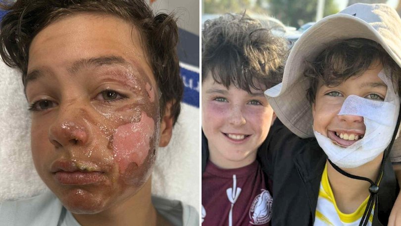 Gold Coast boy Lucas Baldock has been badly burnt in an incident involving a deodorant can. GoFundMe