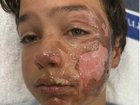 Gold Coast boy Lucas Baldock has been badly burnt in an incident involving a deodorant can. GoFundMe