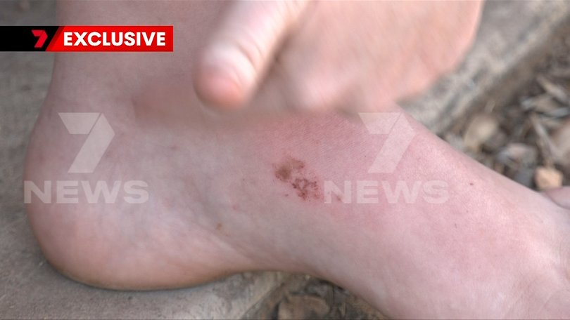 Doctors concluded it was a dry bite, meaning no venom was released from the snake into her foot.