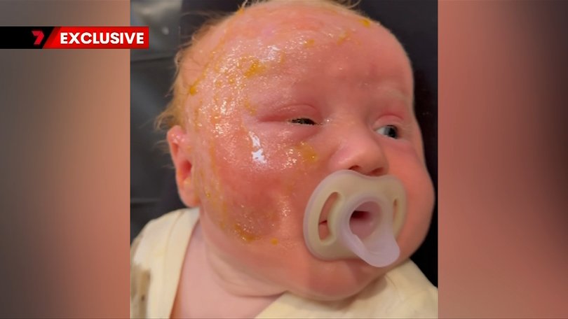 Ten-week-old Lucy Goddard was treated for second-degree burns in hospital after being sunburnt two weeks ago.