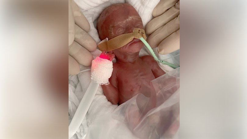 A baby born 16 weeks early survived after months of extensive care.