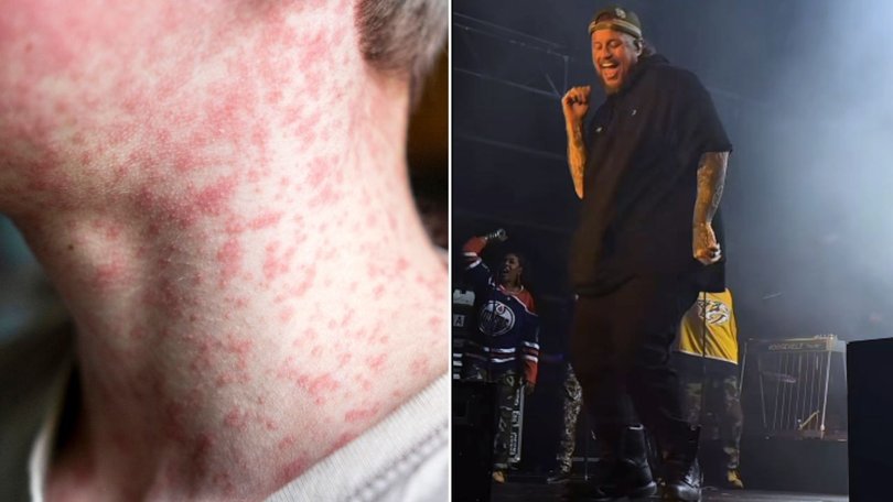 A public health alert has been issued after three people with measles attended Jelly Roll’s Brisbane concert.