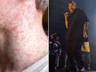 A public health alert has been issued after three people with measles attended Jelly Roll’s Brisbane concert.