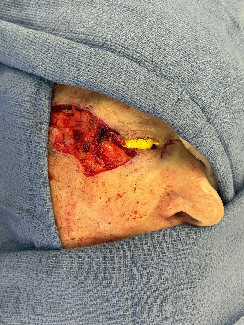 Within days, he operated, removing the disease and beginning a complex reconstruction that involved cutting out part of her lower eyelid and grafting flesh to restore it.