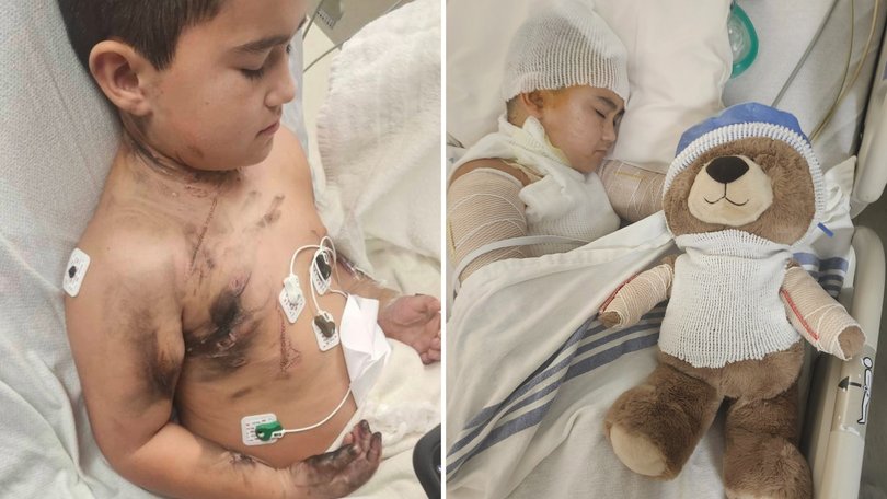 An eight-year-old boy is recovering from a freak phone charger accident that left him with severe burns across his body.
