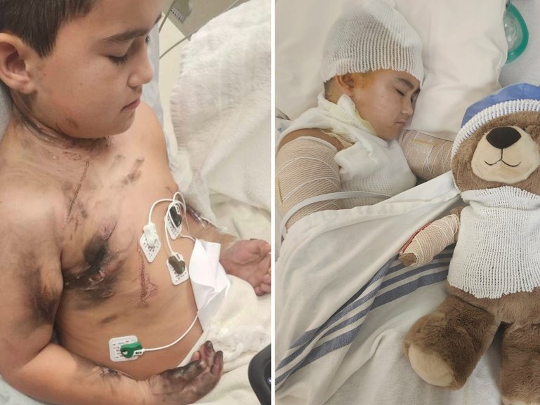 An eight-year-old boy is recovering from a freak phone charger accident that left him with severe burns across his body.