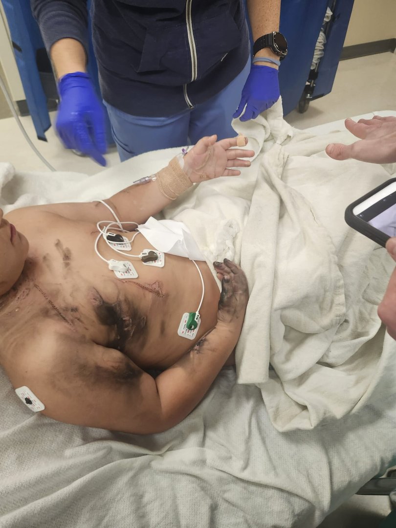 The boy suffered severe burns to his neck, hands, chest, torso and arms.