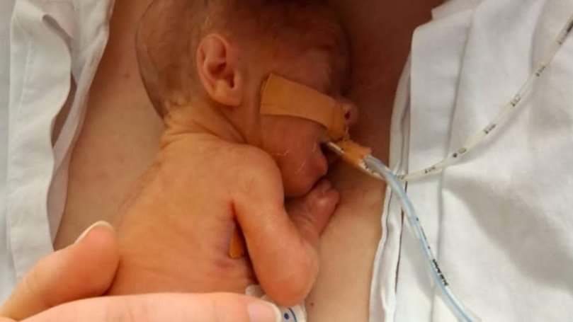 Tiny newborn Charlie Jones was born prematurely, weighing 360 grams.