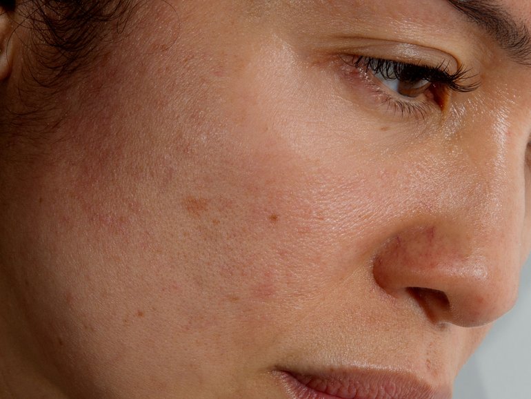 If you suffer from Rosacea, these tricks could help.  