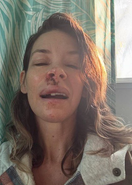 Lily was taken to hospital for treatment after her fall.