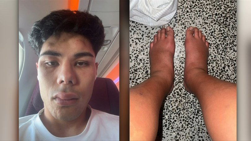 Paul Curtis with his swollen face and feet.