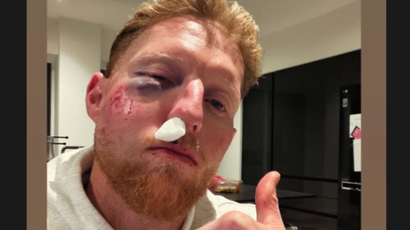England cricket star Ben Stokes has suffered severe facial injuries after being struck by a cricket ball during a training session.