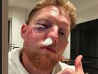 England cricket star Ben Stokes has suffered severe facial injuries after being struck by a cricket ball during a training session.