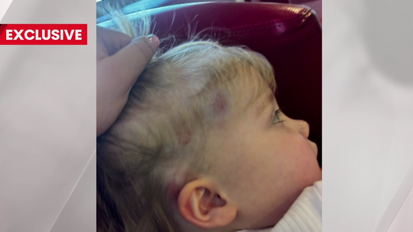 Bruises on Matilda’s head.