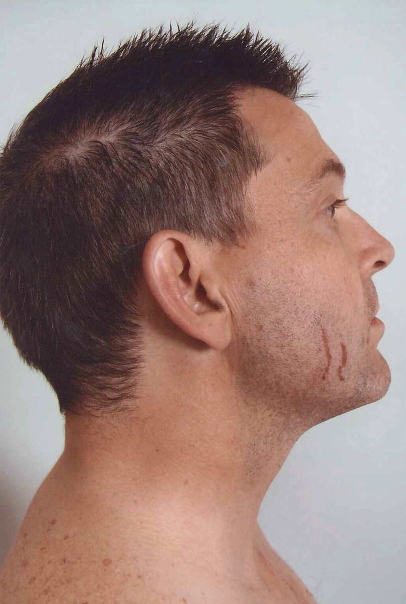 A supplied undated image of scratches on the face of Gerard Baden-Clay. The image was presented as evidence on Wednesday, June 18, 2014, in the trial of Gerard Baden-Clay.