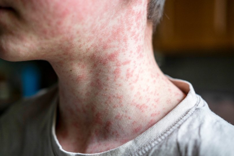 NSW Health is advising people to be alert for signs and symptoms of measles after being notified of four new cases across the state.