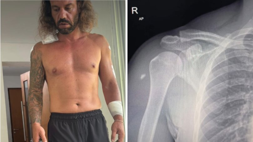 Mr Saban was rushed to hospital by ambulance, where his wounds were treated, but X-rays revealed shards of glass embedded deep in his shoulder and legs, requiring surgery.