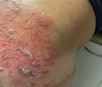 Angelo Fevola said his case of shingles was “shocking”.