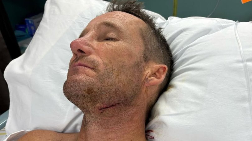 Champion jockey Damien Oliver has come off second best after a surfing accident.
