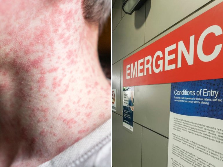 A measles alert has been issued for western Sydney