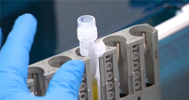 A blood test could identify patients sooner.