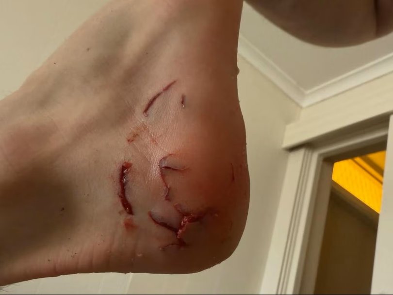 The wound was left unstitched to avoid infection.