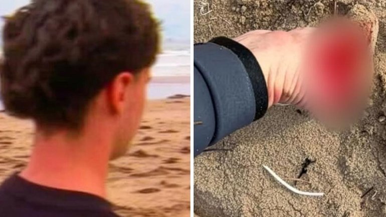 A 16-year-old surfer said he was lucky to escape serious injury after a shark reportedly bit his foot over the Easter weekend.