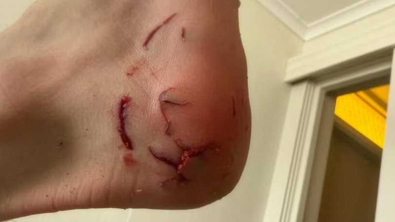 Authorities said the bite may have been caused by a juvenile shark, but the species is unconfirmed. Photo: Supplied