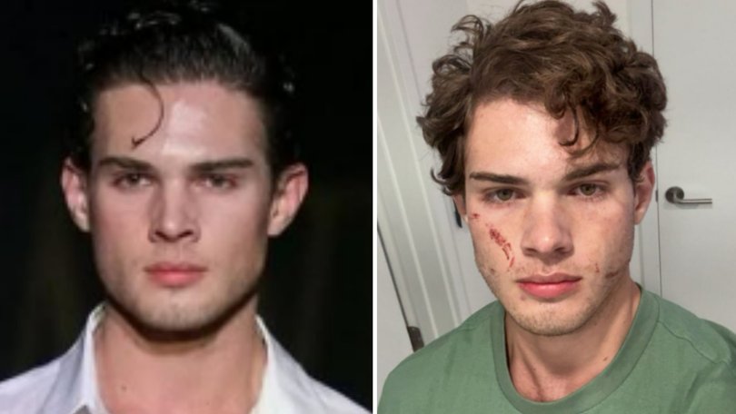 'Lookmaxxer' influencer speaks out after being discharged from hospitial.