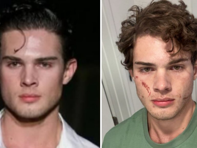 'Lookmaxxer' influencer speaks out after being discharged from hospitial.