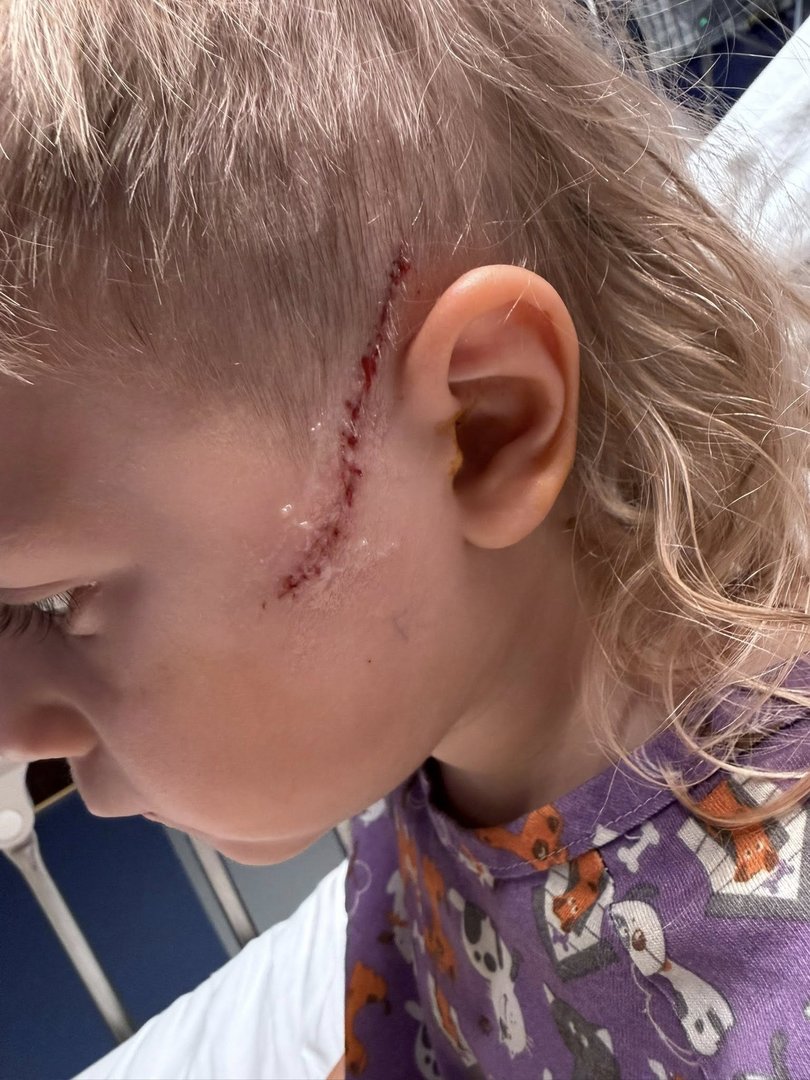 Cyler's stiches after the incident.