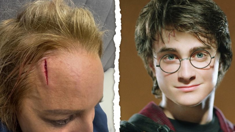 Carrie Bickmore has been compared to Harry Potter following her nasty facial injury.