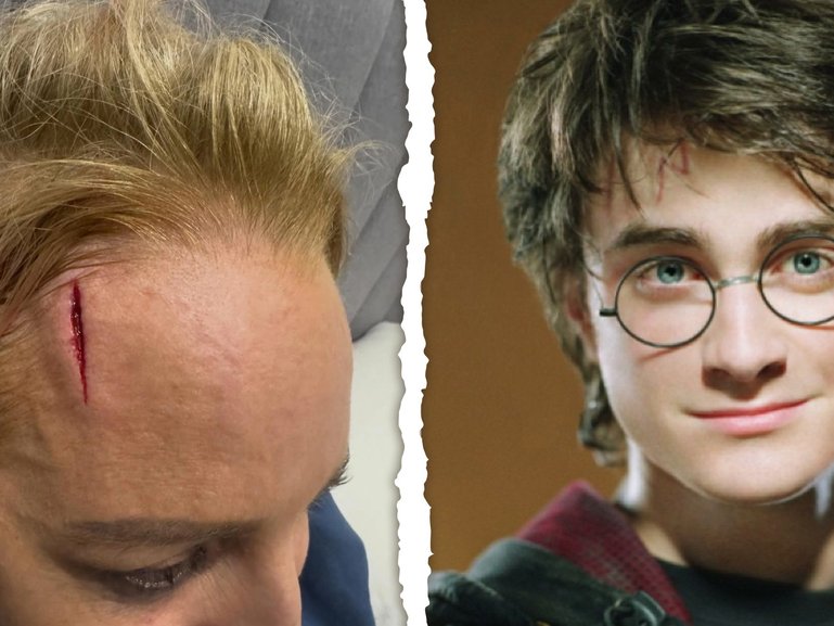 Carrie Bickmore has been compared to Harry Potter following her nasty facial injury.