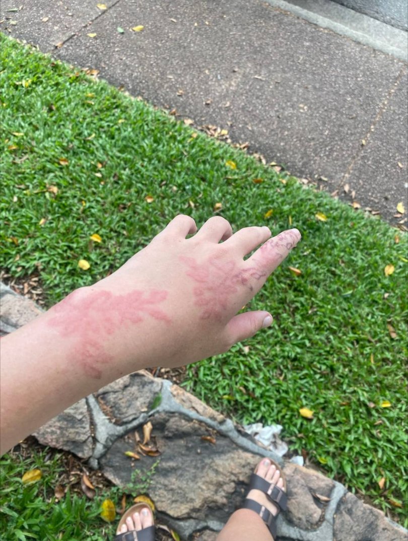 The daughter reacted to the henna, with red scabby skin forming where the design once was. 