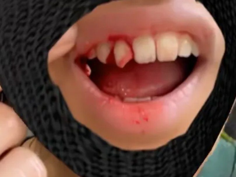 The cafe worker faces a potentially costly dental bill. Picture: GoFundMe