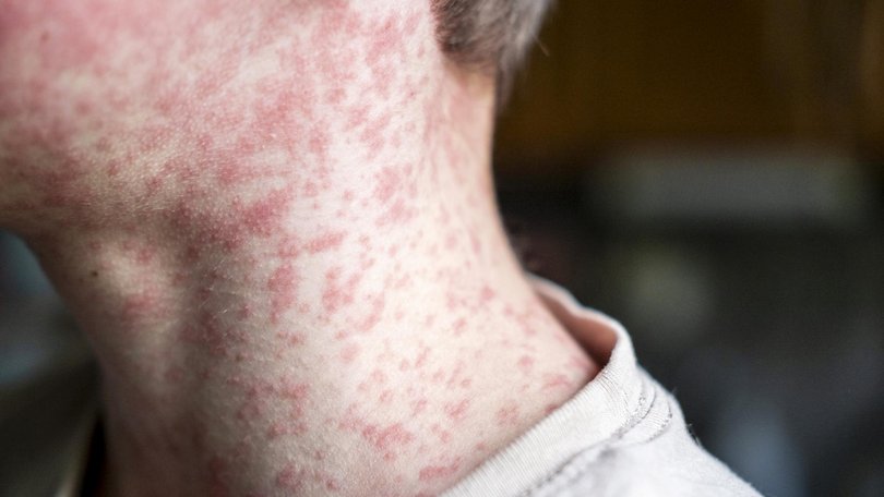 Symptoms to watch out for include fever, sore eyes, runny nose and a cough, usually followed three or four days later by a red, blotchy rash that spreads from the head and face to the rest of the body.